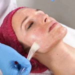 Services chemical peel